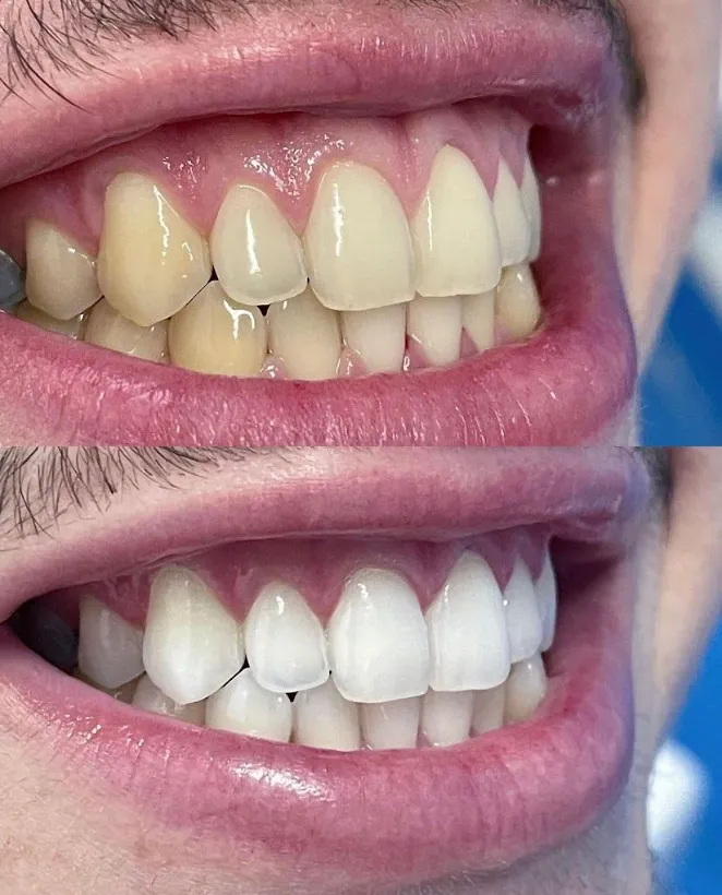 Antes e depois de clareamento dental