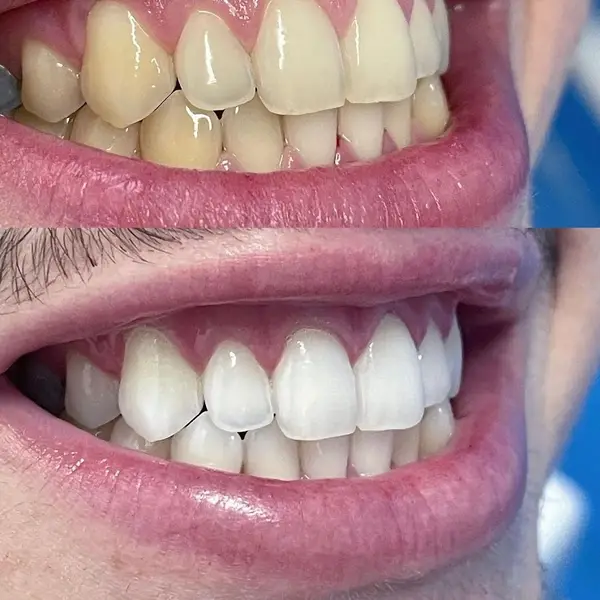 Composicao empilhada com dois estados do mesmo sorriso lateral: dentes amarelados em cima, clareados embaixo