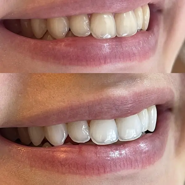 Composicao empilhada de sorriso feminino em tres quartos, antes em cima e depois clareado embaixo