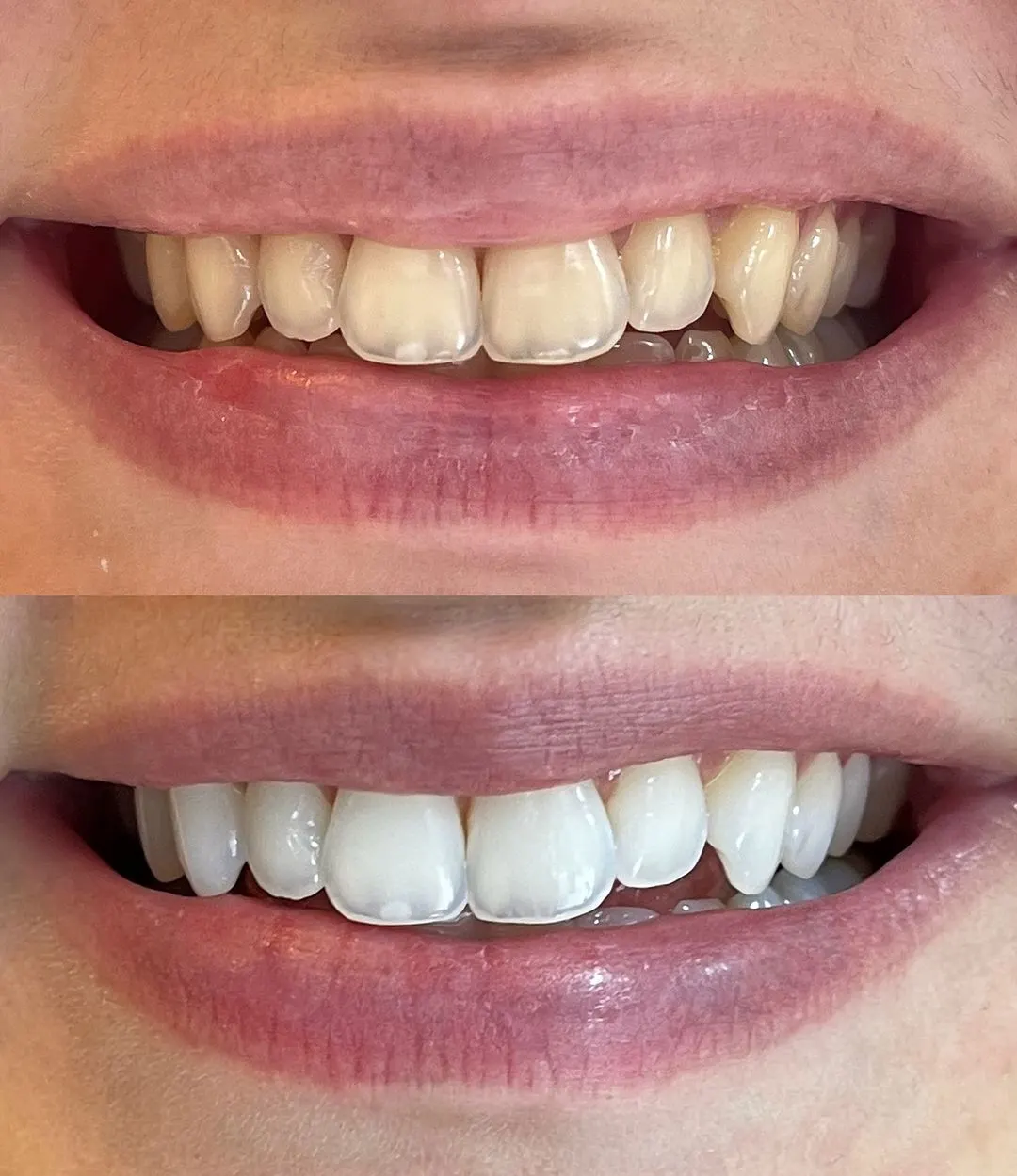 Sorriso de paciente da Humanized antes e depois do clareamento dental