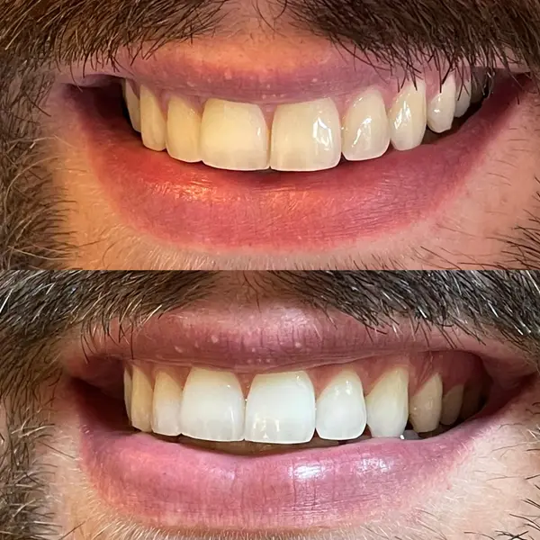 Composicao empilhada do sorriso de um homem barbado, antes e depois do clareamento