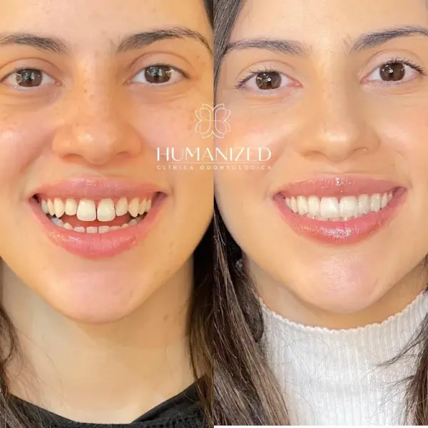Colagem lado a lado do rosto inteiro de uma paciente, com a logo HUMANIZED no centro separando antes e depois