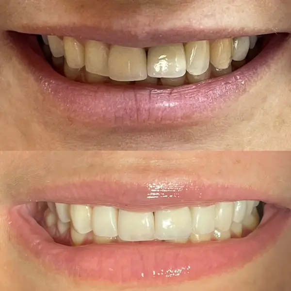 Composicao empilhada de sorriso frontal antes e depois das facetas