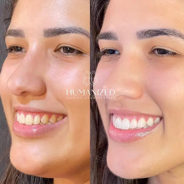 Colagem lado a lado do rosto de uma paciente sorrindo, com logo HUMANIZED no centro