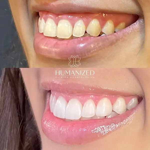 Composicao de dois closes do sorriso lateral da mesma paciente, antes e depois, com logo da clinica