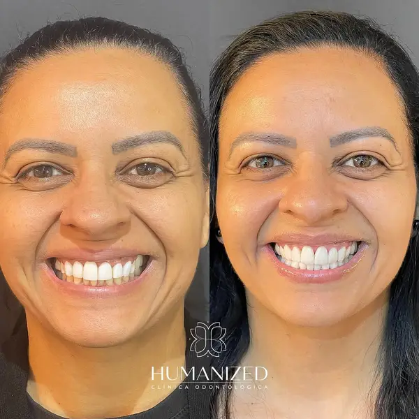 Colagem lado a lado do rosto de uma paciente adulta sorrindo, antes e depois, com logo HUMANIZED