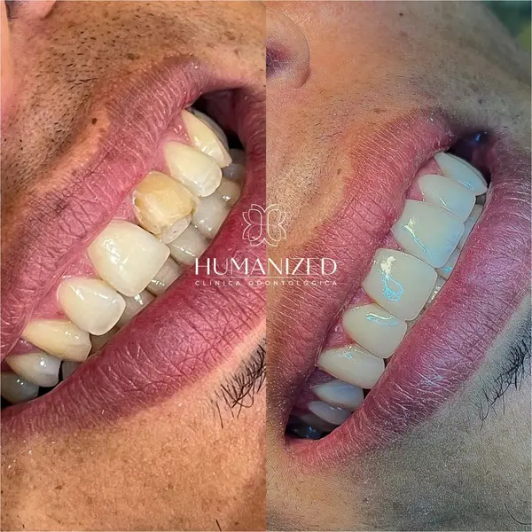 Colagem lado a lado de close lateral da boca de um homem, antes e depois, com logo da clinica