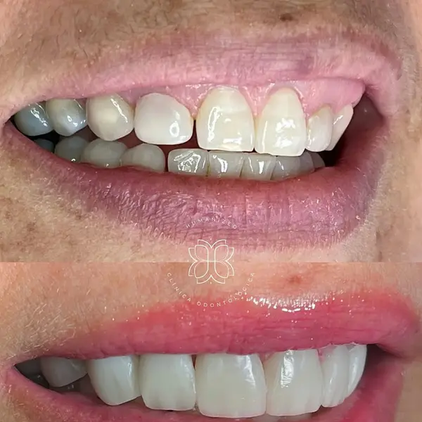 Composicao empilhada de close lateral da boca, antes e depois, com logo HUMANIZED na divisa