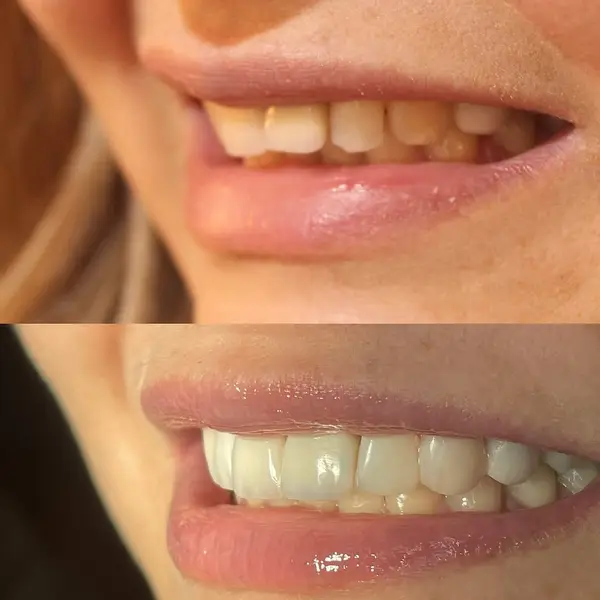 Composicao empilhada de close da boca de uma paciente, antes com dentes desalinhados e depois com facetas