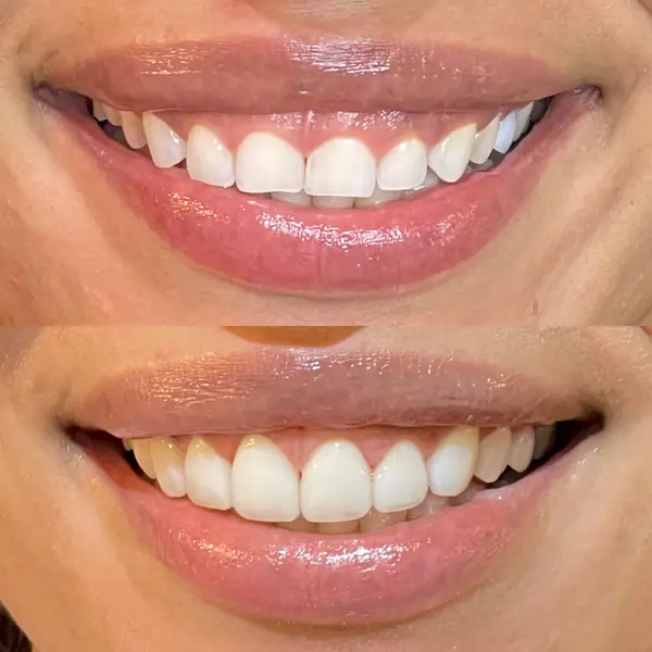 Composicao empilhada de sorriso frontal feminino, antes com gengiva aparente e depois com facetas