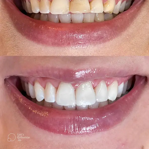 Composicao empilhada de sorriso com dentes manchados em cima e restaurados embaixo, com marca d'agua 'Let's Enhance.io'