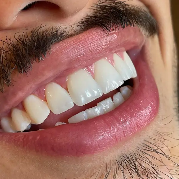 Close intraoral unico do sorriso de um homem de barba, identico ao de 2024-12-10 18.00.32