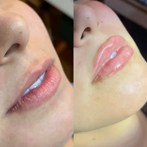 Colagem lado a lado do perfil da boca de uma paciente, antes e depois de preenchimento labial
