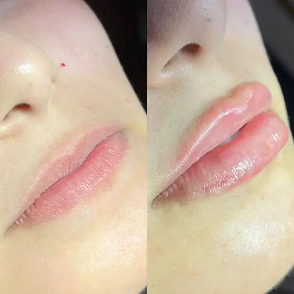 Colagem lado a lado do perfil da boca, antes e depois do preenchimento labial, crop levemente mais fechado