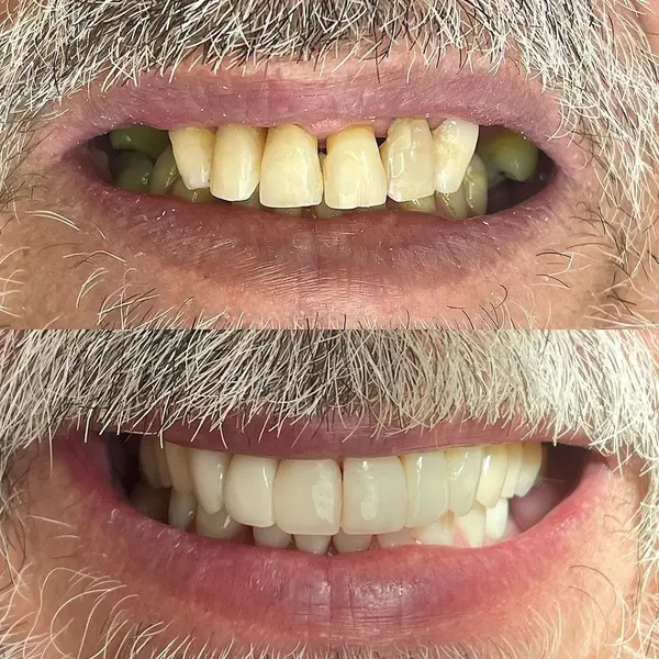 Composicao empilhada do sorriso de um homem grisalho, antes com dentes desgastados e depois reabilitado