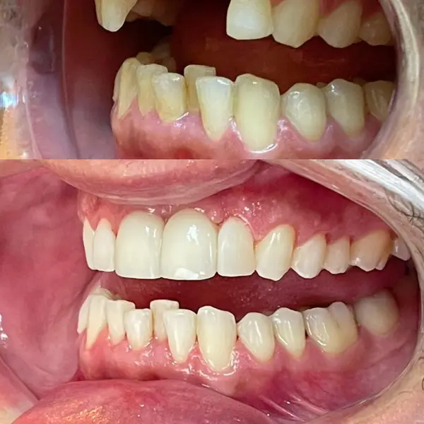 Composicao empilhada intraoral com afastador, mostrando ausencia de dentes em cima e a reabilitacao instalada embaixo