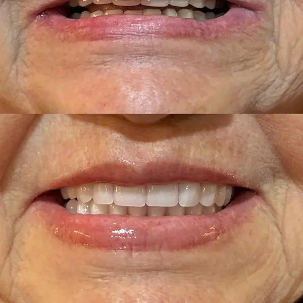 Composicao empilhada da boca de uma paciente idosa, antes com dentes ausentes e depois com protese instalada