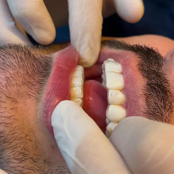 Maos enluvadas ajustando o alinhador transparente na boca de um paciente barbado, em close bem fechado