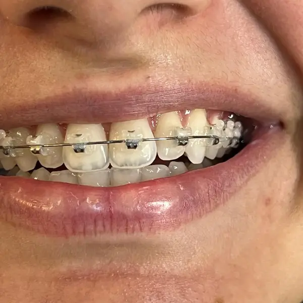 Close intraoral unico de um sorriso com aparelho fixo de bracketes esteticos e fio metalico